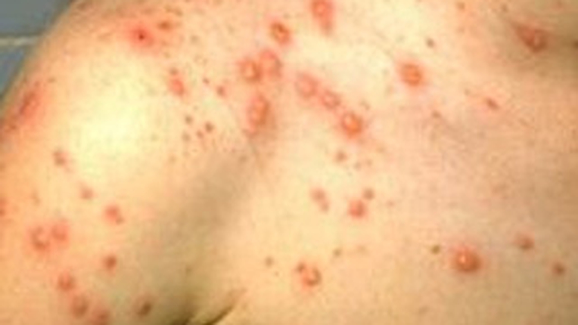 O fata de 11 ani bolnava de varicela a murit, dupa ce bunica ei a dat-o cu o solutie toxica crezand ca are raie