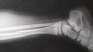 Neglijenţa cadrelor medicale poate fi fatală!O fetiţă de 4 ani a murit în urma unei fracturi la picior!