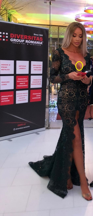 Bianca Drăgușanu, cu o vânătaie imensă pe bust. A fost lovită în sâni?!