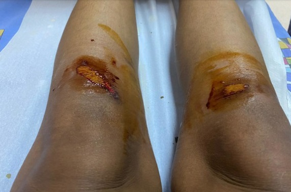 Laurette, plină de răni după episodul violent din hotel. Cum arată genunchii mulatrei: „Era plin de sânge la gură ca un canibal”