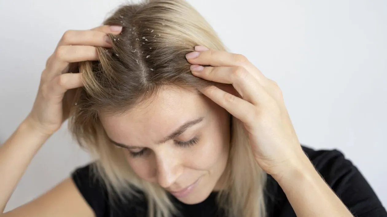 Când scalpul cere ajutor: dermatita seboreică și soluțiile naturale care pot calma pielea