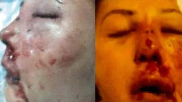 Au avut nevoie de poze ca sa ii reconstruiasca fata! Cum arata acum femeia snopita in bataie de iubitul exagerat de gelos