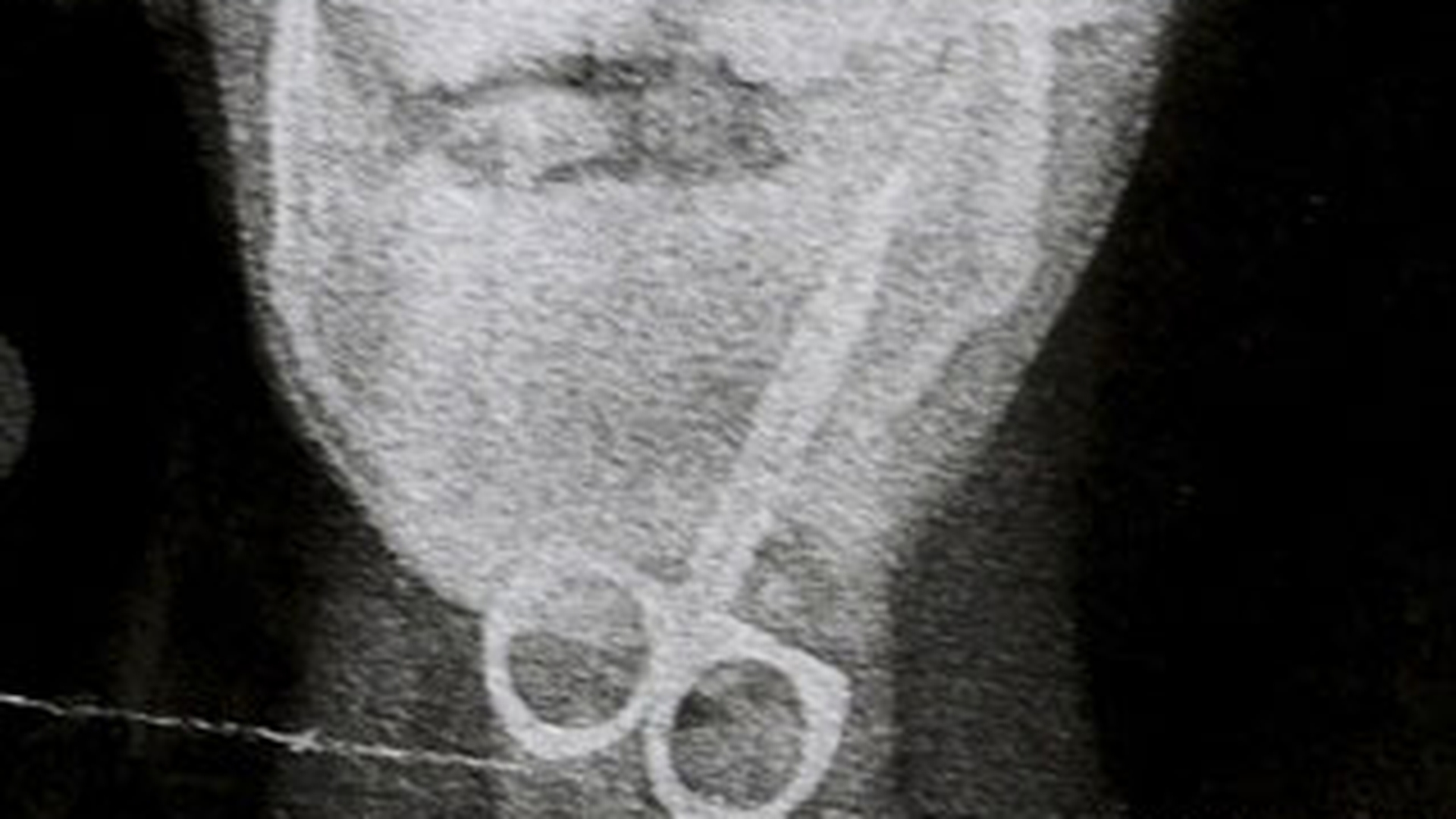 Un copil de 12 ani a ajuns la spital cu foarfecele in gat! Nu a stiut ca nu e bine sa-l inghita!
