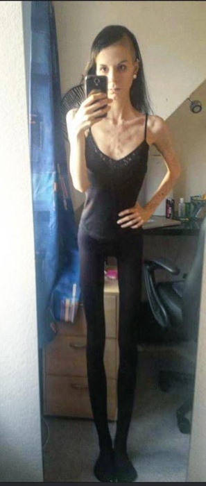 Cazul şocant al fetei care îşi ascundea mâncarea în urechi! Julia cântărea 32 de kilograme, dar a învins anorexia. Cum a reuşit!