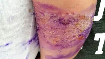 Revoltător! Copil de doi ani infectat grav de la un leucoplast aplicat în spital