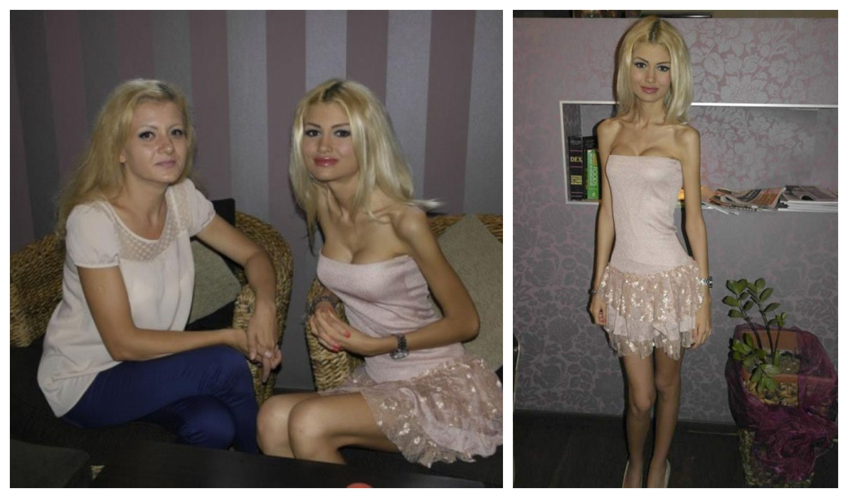 În 2013, anorexica Flavia Apostol avea doar 38 kg la 1.72 m! Cum arată acum și câte kilograme are