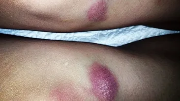 Pasiunea naste VANATAI si dureri cumplite! O bruneta din showbiz trece prin momente grele: S-a accidentat!