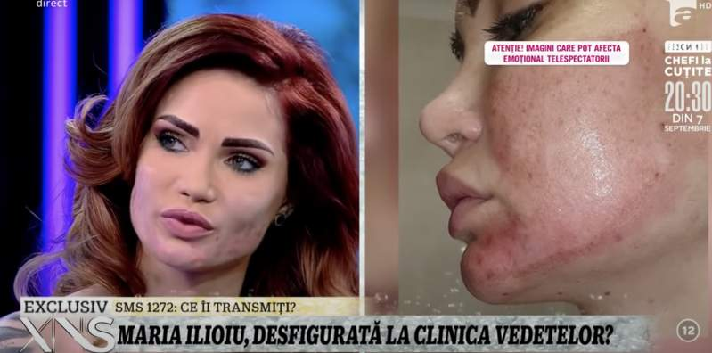 Maria Ilioiu, declarații de coșmar după ce a fost mutilată la „clinica vedetelor”: „Fața mea este tăbăcită, cu gropi”