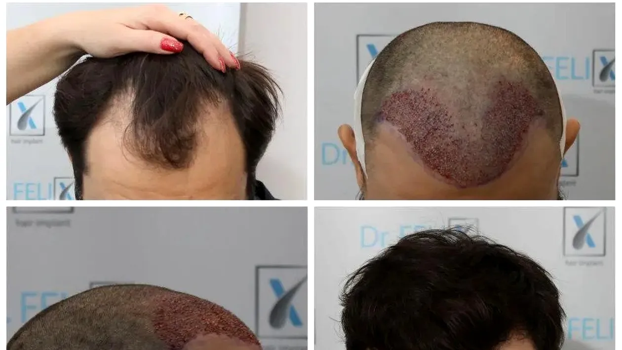 (P) Află aici mai multe despre implantul de păr