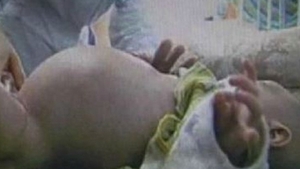 A uimit lumea medicală! Un băieţel de numai doi ani şi-a născut propriul FRATE! VIDEO IREAL