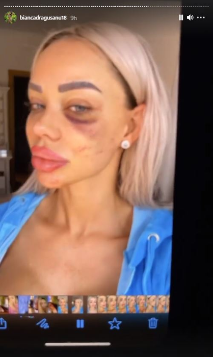 Bianca Drăgușanu a publicat mai multe imagini după ce a fost snopită de Alex Bodi: “Pentru pozele în care apar bătută, am depus o plângere penală” | FOTO