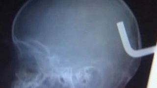 VIDEO Un bebelus a scapat cu viata, dupa ce i-a intrat in cap o tija metalica de sapte centimetri