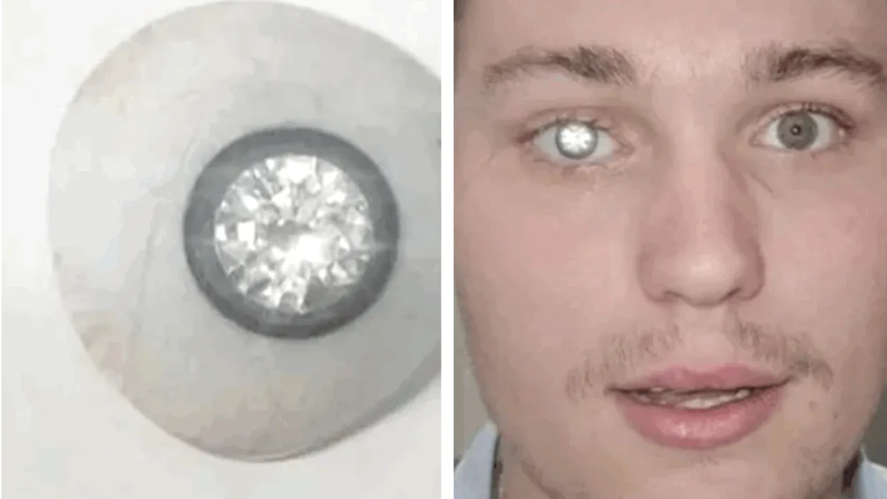 Povestea tânărului care și-a pus un diamant de 2 milioane de dolari în loc de ochi: ”A adus o lumină nouă în viața mea”