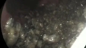 Medicii au fost socati cand au vazut ce are acest barbat in nas! Erau acolo de cel putin 5 ani