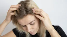 Când scalpul cere ajutor: dermatita seboreică și soluțiile naturale care pot calma pielea