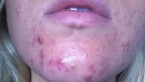 S-a spălat pe faţă cu bicarbonat de sodiu, ca să scape de acne! Rezultatul a şocat-o