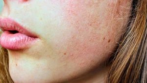 Persoanele cu un ten sensibil, probleme din cauza măștii de protecție! Ce este dermatita alergică de contact și cum scapi de ea. Sfatul medicilor