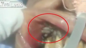 VIDEO & FOTO / Un stomatolog a rămas marcat pe viaţă. Ce a găsit în gura unui pacient! NU te uita dacă nu ai un stomac tare
