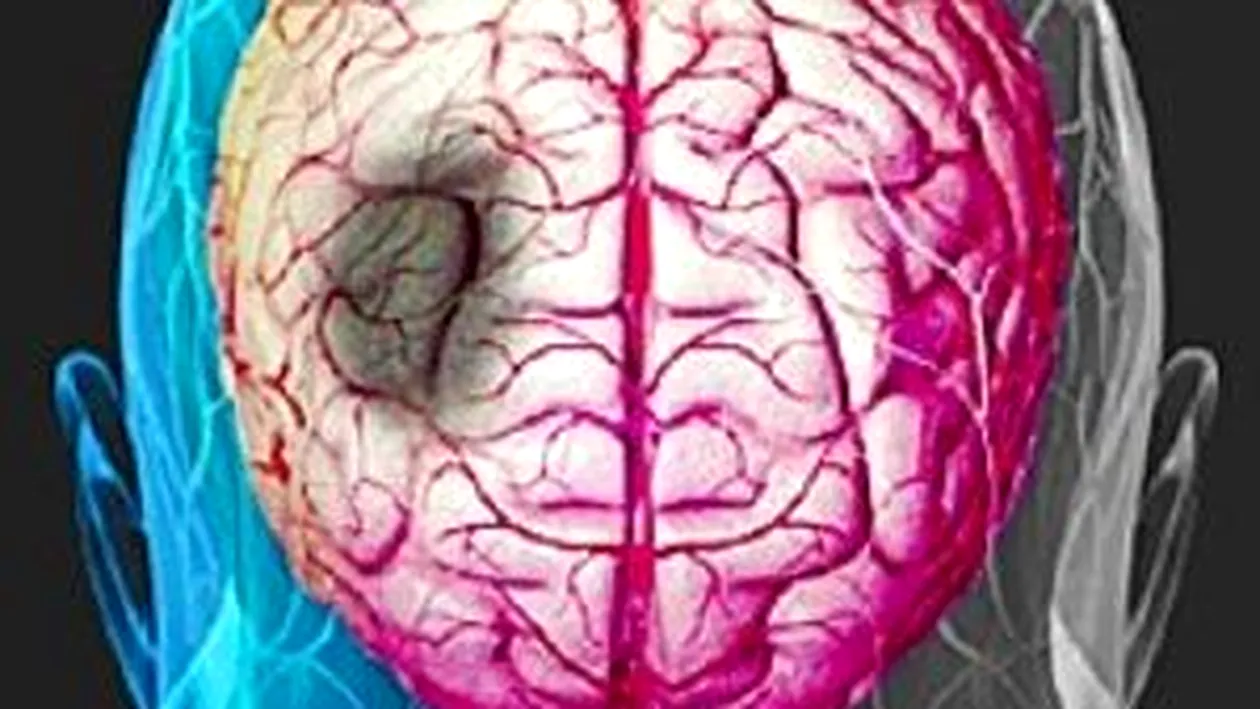 Cel mai rapid mijloc de diagnosticare a accidentului cerebral de către nespecialiști