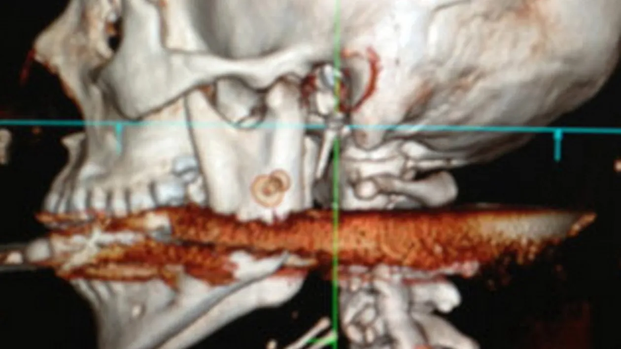 HORROR! Cum arata aceasta tanara frumoasa frumoasa dupa ce a fost impuscata cu un harpon in gat