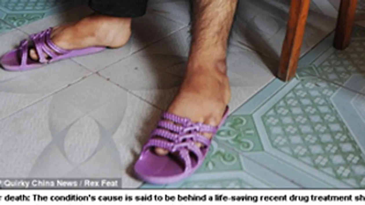 Ai sa ramai socat! Unei fete de 16 ani i-a crescut barba, in urma unui tratament pentru o boala rara! NU ai sa crezi ca este femeie!