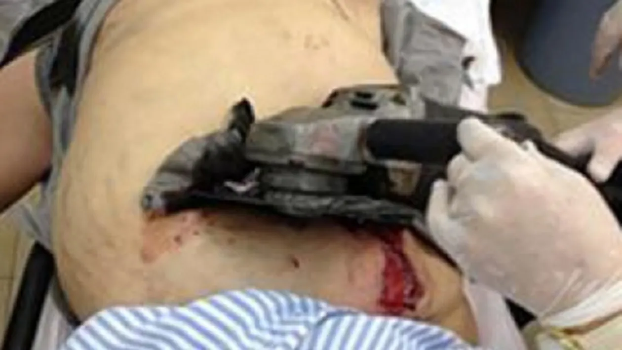 Medicii au fost socati cand l-au vazut! Un barbat a supravietuit dupa ce a avut asa ceva infipt in el