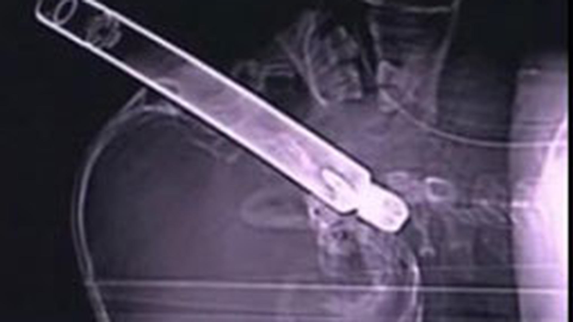 VIDEO A ajuns la spital cu o teava de 30 cm infipta in cap