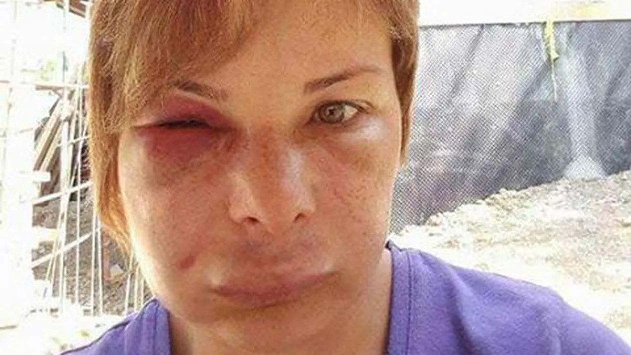 Atenţie, imagini cu un puternic impact emotional! A desfigurat-o stomatologul! I-a scos 4 măsele, iar rezultatul este TERIFIANT