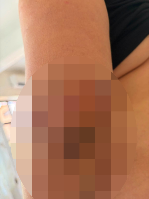 Vânâtăile din urma agresiunii pe care a primit-o Angelo Dumitrache