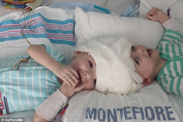 Emoţionant! Doi gemeni se privesc în ochi, după ce s-au născut lipiţi în zona capului