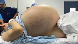 A avut o tumora la ovare care i-a ocupat 95% din abdomen. Ce s-a intamplat cu tanara dupa ce a fost consultata de medici 