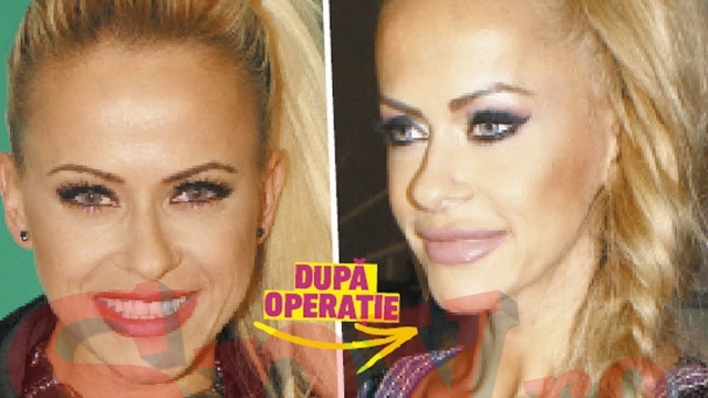 "Buzele tale, operate-n graba mare" Anda Adam, cap de lista in topul operatiilor estetice terminate prost!