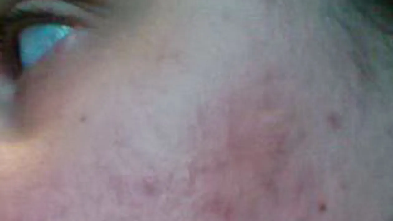 A luat medicamente ca sa scape de COSURI, dar a fost la un pas sa ORBEASCA! Ce a patit aceasta tanara