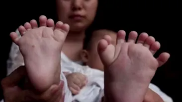 Medicii au fost şocaţi! Aşa arată băiatul care s-a născut cu 31 de degete la mâini şi la picioare