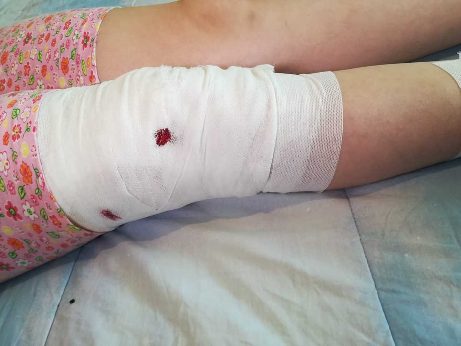 Fetiță de 10 ani din Mediaş, atacată de un câine maidanez. Copilul a fost mușcat de nas, mâini și picioare | VIDEO