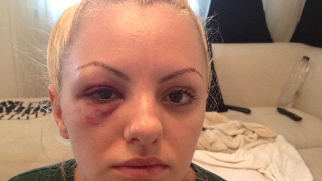 Imagini-soc! Alexandra Stan, snopita in bataie! “Accidentul a fost o inventie! Managerul meu m-a batut pana m-a bagat in spital”