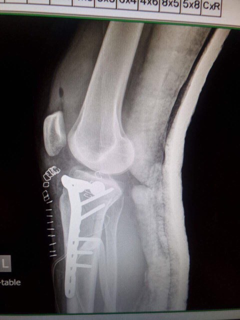 Radiografia piciorului lui Dee Dee de la ”Insula iubirii”