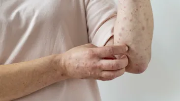 Alertă medicală în România! Medicii trag un semnal de alarmă după creșterea neașteptată a numărului de cazuri