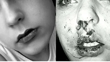Povestea incredibilă a unei tinere autiste desfigurate de o gaşcă de bătăuşi! Le-a râs în nas şi a devenit model!