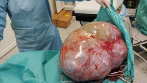 FOTO. Caz incredibil la Botoșani. Tumoare de 24 de kilograme, extirpată din abdomenul unei femei infectată cu COVID-19