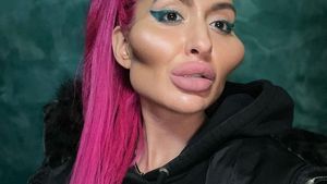 Cum a ajuns să arate o femeie dependentă de botox! Doctorii i-au spus să se oprească