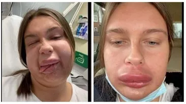 A vrut să aibă buze cărnoase și senzuale, dar a trecut printr-un adevărat coșmar. Ce a pățit o tânără din Londra