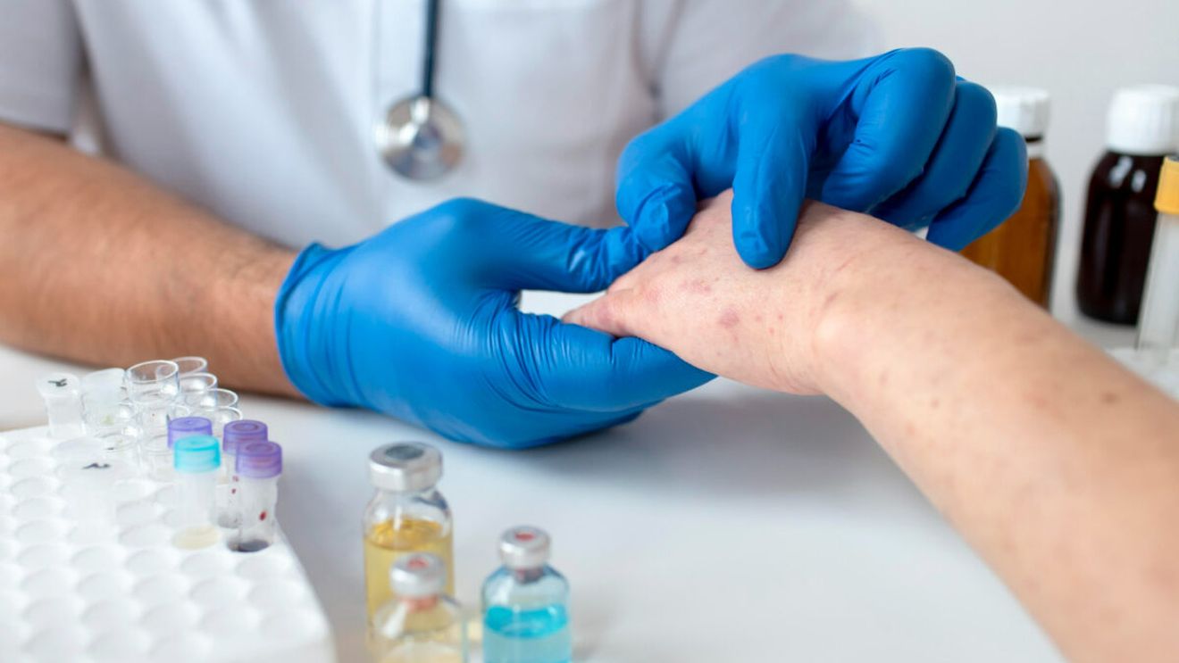 Ce simptome are lepra și cum se transmite, de fapt. Patru cazuri de boala Hansen au fost depistate la Cluj-Napoca