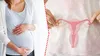 Femeie născută fără uter, însărcinată după ce a primit un transplant de la sora ei. A ajuns în săptămâna 26 de sarcină