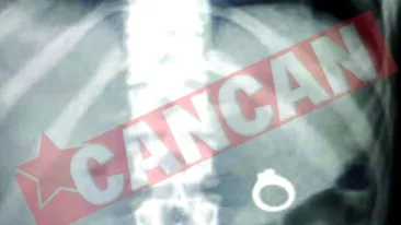 Si-a inghitit inelul de logodna