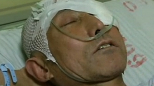 A avut un accident casnic si s-a dus de urgenta la spital! Ce au gasit medicii in craniul lui: "Nu am simtit cand a intrat"