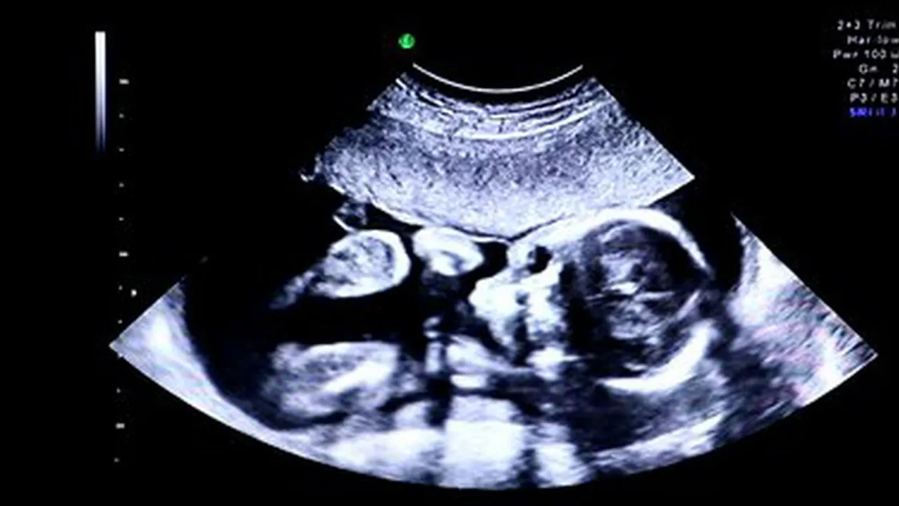 Doctorii au fost ingroziti cand l-au vazut pe acest bebelus: avea 4 maini si 4 picioare! A fost operat la 9 zile dupa nastere