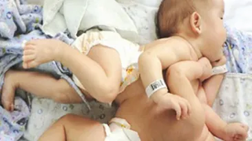 VIDEO Caz rar la Pitesti! Doua fetite siameze au aceeasi inima!