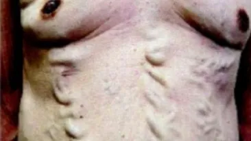 BOALA misterioasa de care sufera acest barbat. Cum a ajuns sa arate asa! Medicii nu au nicio explicatie