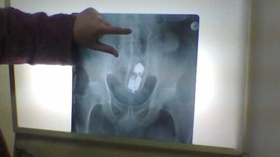 Șocant. Un tânăr din Olt a ajuns la Urgență după un ”accident casnic” ciudat: ”Mama lui a spus că...”